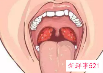 女孩子腺样体肥大有什么后果