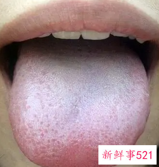 感冒舌苔厚白怎么办