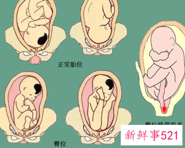 什么原因会导致臀位破水