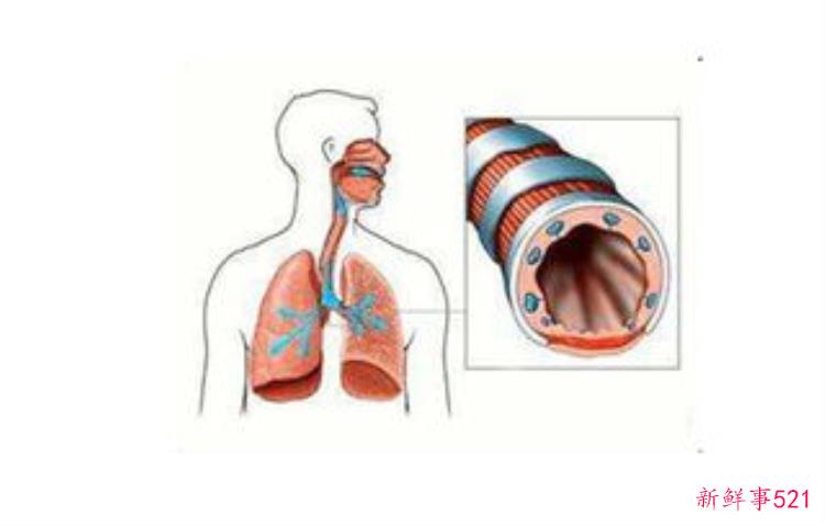 什么原因导致气管炎「气管炎发病原因」
