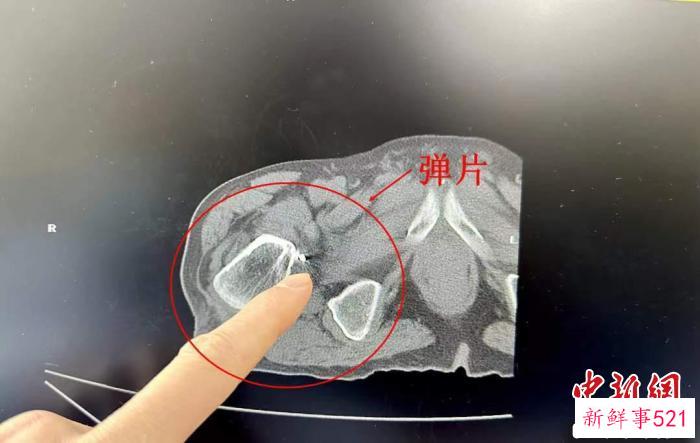 弹片位置 李烨 供图