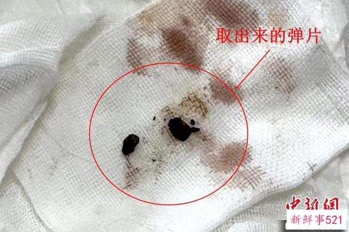 取出来的弹片 李烨 供图