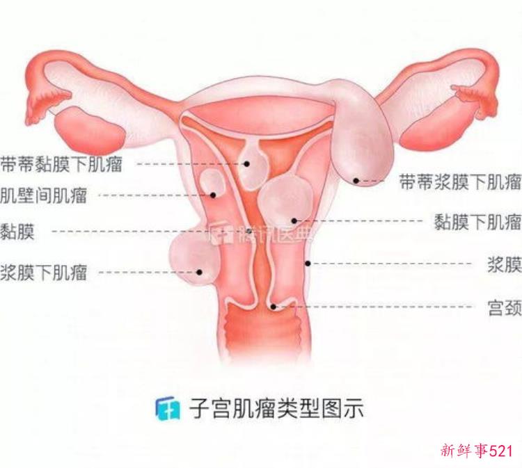 子宫畸形，子宫畸形对生育的影响
