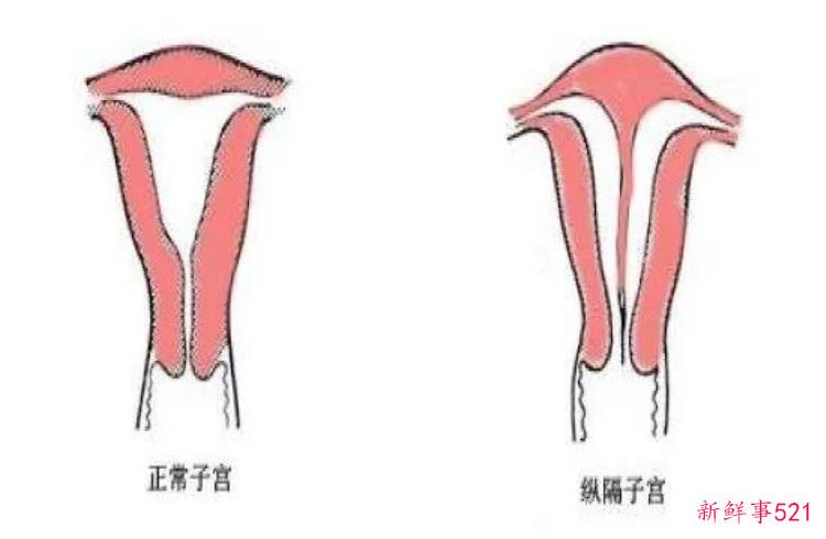 子宫畸形，子宫畸形对生育的影响