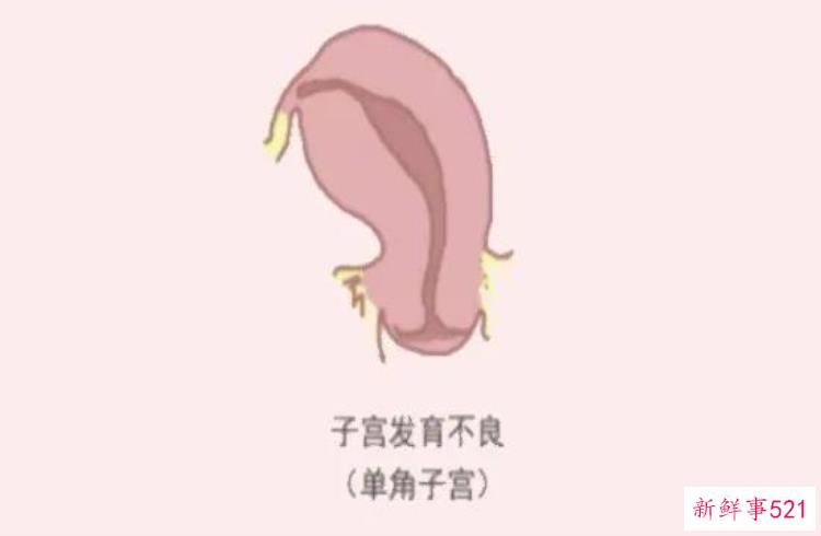 子宫畸形，子宫畸形对生育的影响