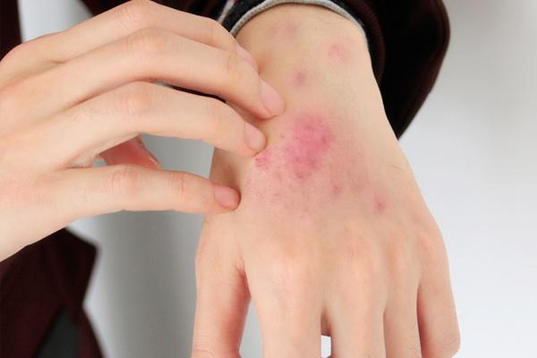 肛门处的小肉疙瘩是什么？可能不只是痔疮这么简单，提前了解