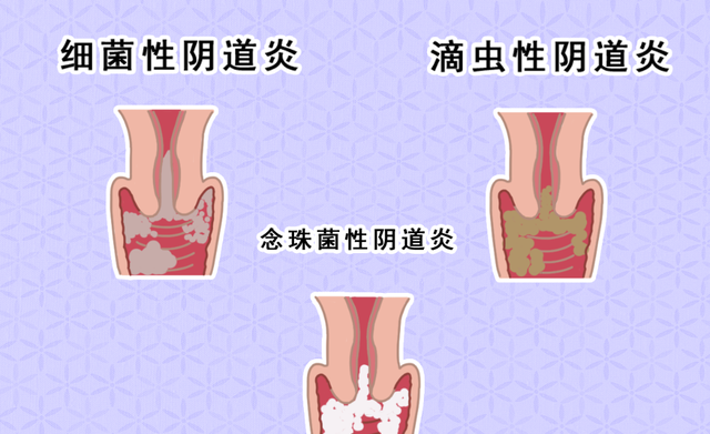 女性朋友注意！下身有这4种变化，警惕阴道肥大，4大危害难以启齿