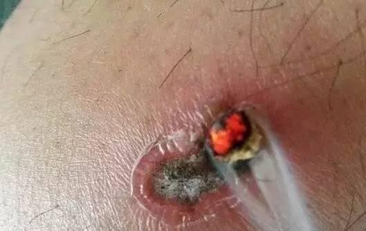 颧髎穴，脸上的穴位，治疗各种面部疾患，牙痛，脸部抽搐，歪嘴等