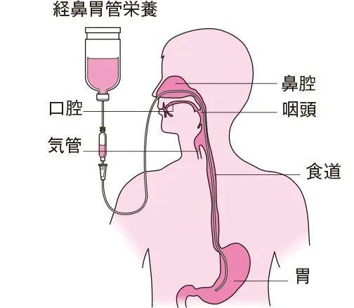 日本14岁少女被绑床上折磨77天！只因患上厌食症？！医院仅被罚110万