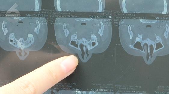 昆明美女花3万元隆鼻，鼻子歪了？无法通气？医院：她太没良心