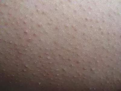 鸡皮肤女生夏日自救!如何科学嫩肤提升精致度?