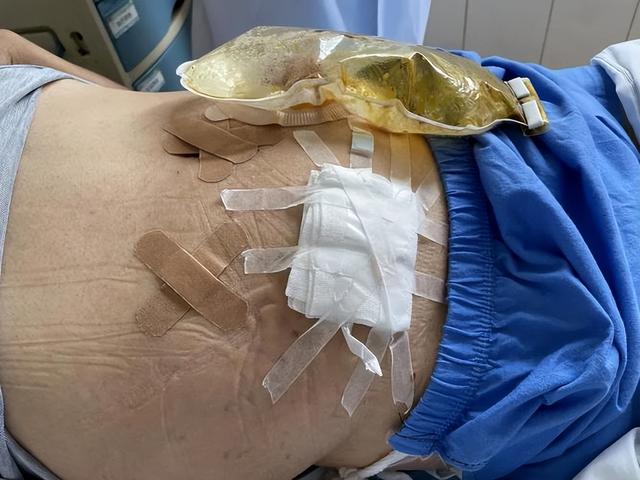 90后美女，为活命切除全身大量器官，开直播却遭网友质疑