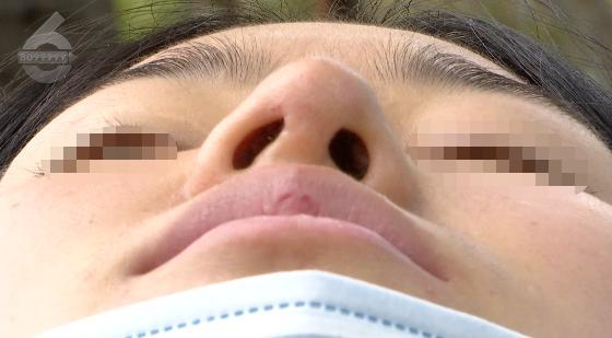 昆明美女花3万元隆鼻，鼻子歪了？无法通气？医院：她太没良心