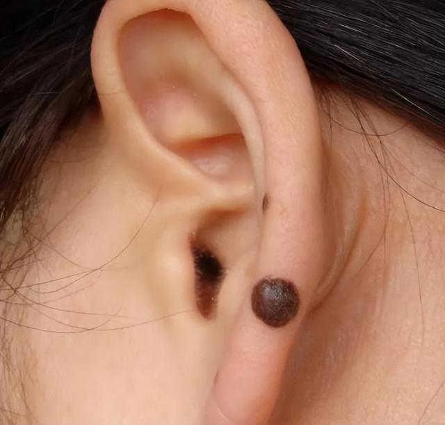 孩子身上这几个“痣”，或是“好福气”的寓意，你家孩子有几个？