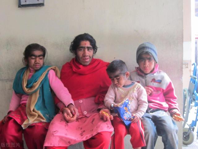 23岁女孩患多毛症，一脸络腮胡，被当怪物，直言想去变性