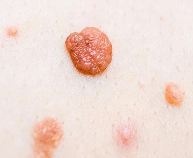 孩子身上这几个“痣”，或是“好福气”的寓意，你家孩子有几个？