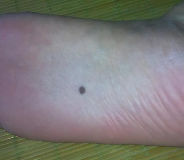 孩子身上这几个“痣”，或是“好福气”的寓意，你家孩子有几个？