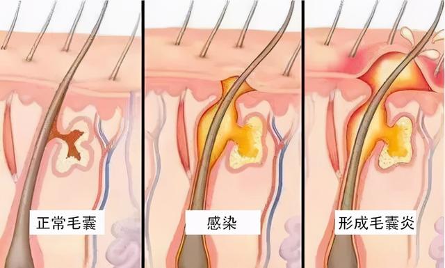 痛得合不拢腿、迈不开步,私处长的这东西到底是啥啊?