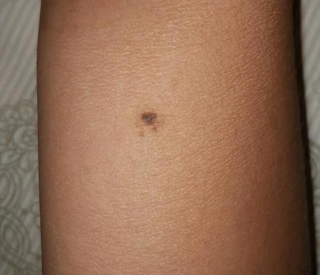 孩子身上这几个“痣”，或是“好福气”的寓意，你家孩子有几个？