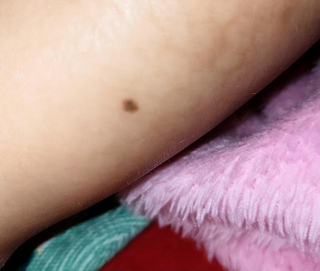 孩子身上这几个“痣”，或是“好福气”的寓意，你家孩子有几个？