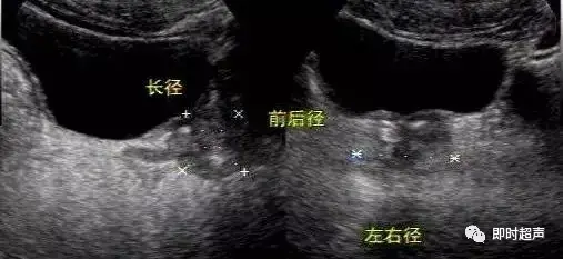 前列腺检查方法、标准切面及测量值汇总