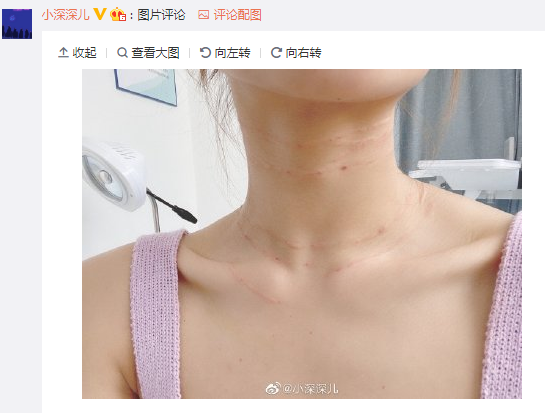 知名美女主播为防皱纹在脖子上打针,看着都疼!刘飞儿也想打?