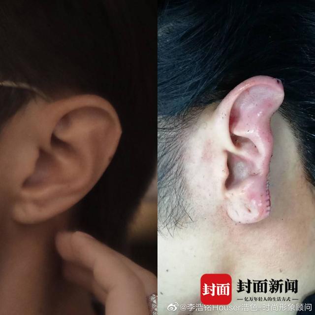 女孩街头被侵害 施救者被咬掉左耳:选择勇敢 不后悔站出来