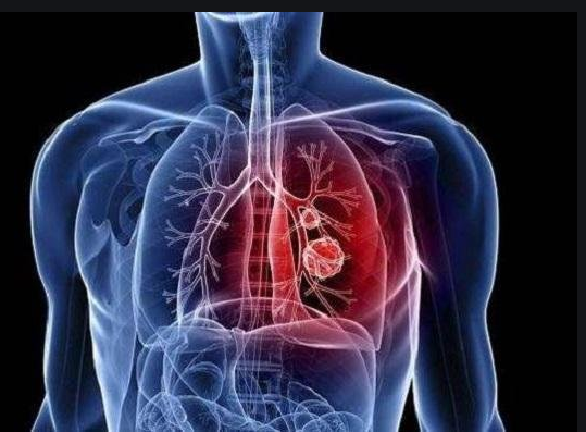 钟南山：逝者解刨发现大量黏液