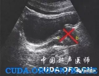 前列腺检查方法、标准切面及测量值汇总