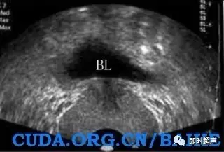 前列腺检查方法、标准切面及测量值汇总