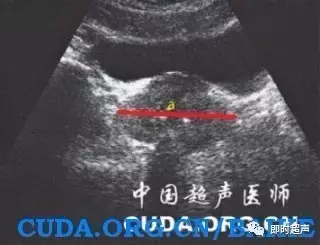 前列腺检查方法、标准切面及测量值汇总