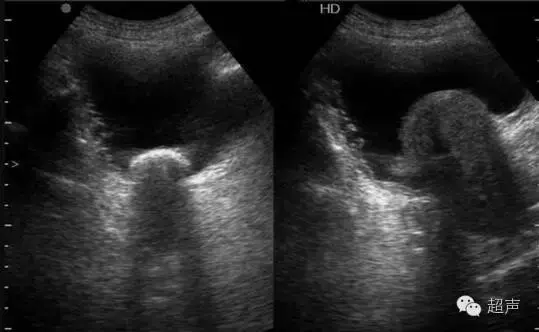 前列腺检查方法、标准切面及测量值汇总