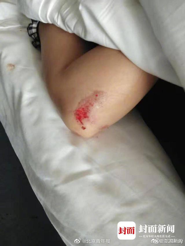 女子遭丈夫拖上山殴打至眼球破裂：表姐发文求助，男方被拘