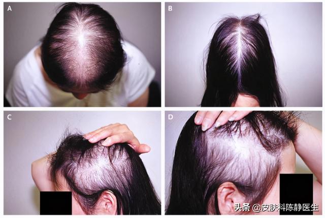 逆转女性脱发~治疗方法及进展