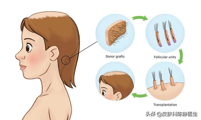 逆转女性脱发~治疗方法及进展