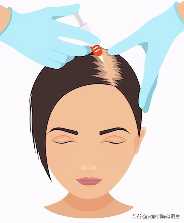 逆转女性脱发~治疗方法及进展