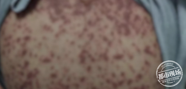 13岁女孩吃药后，竟然全身溃烂、体无完肤！医生紧急提醒