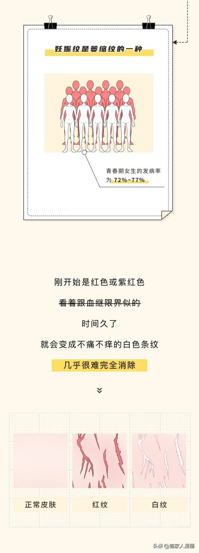 为何很多女生大腿附近会出现一片白色的条纹？