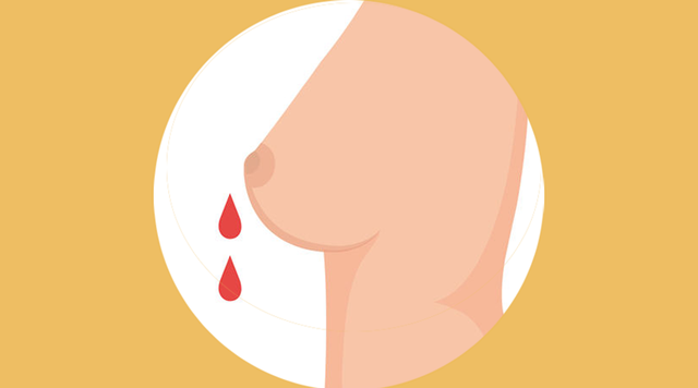 乳房出现这6种变化，是正常现象还是疾病信号？