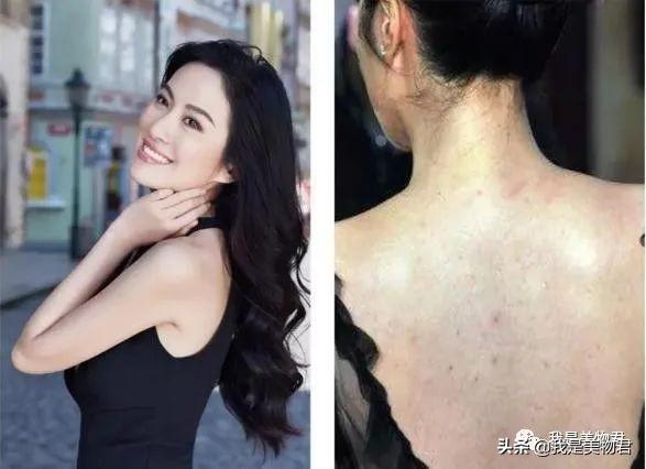 后背祛痘神器｜这6款好物让你拥有光滑美背