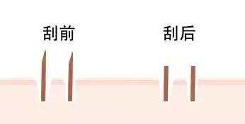 女生为什么会长胡子?女生的胡子会越刮越粗吗?