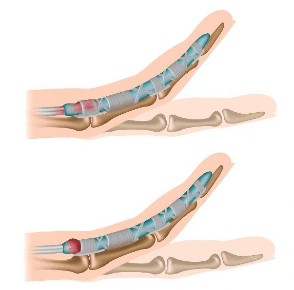 50岁女性频繁发作腱鞘炎，预示着您可能要进入更年期了，请别忽视