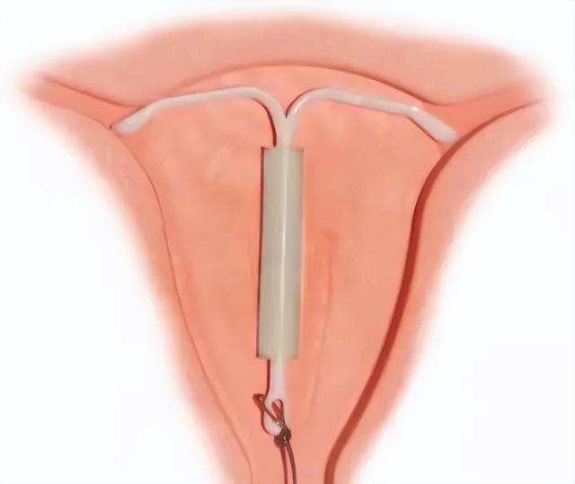 5种常用的避孕方式,第1种女人最喜欢,第4种男人最不愿意