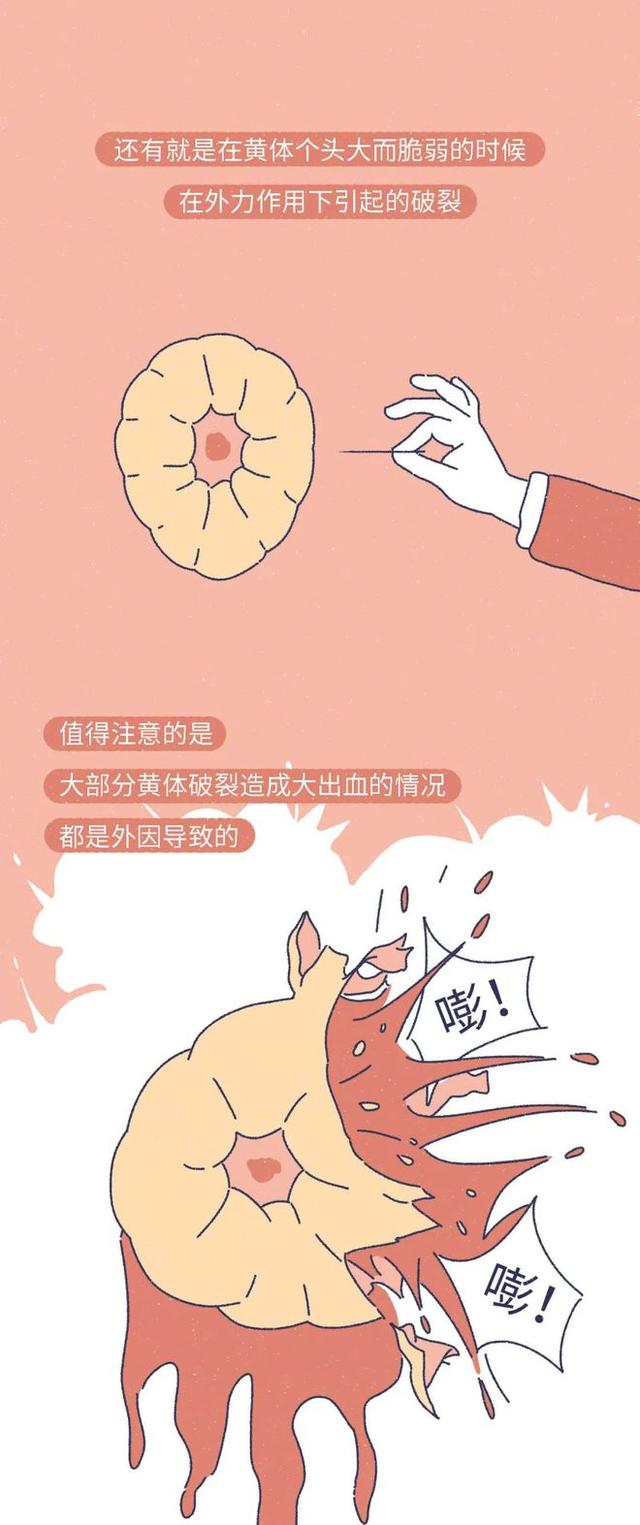 「黄体破裂」有多“可怕”？漫画：其痛苦程度，或许让人难以忍受