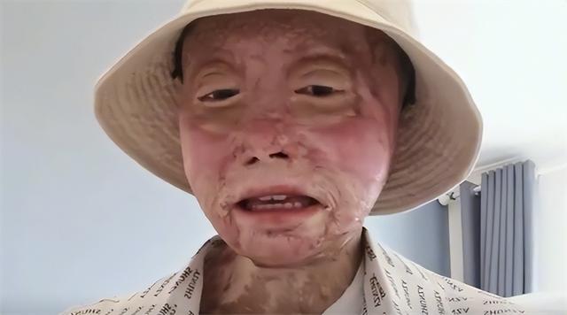 24岁女孩烧伤928天后重生!12次手术仍不放弃,向河南灾情捐500元