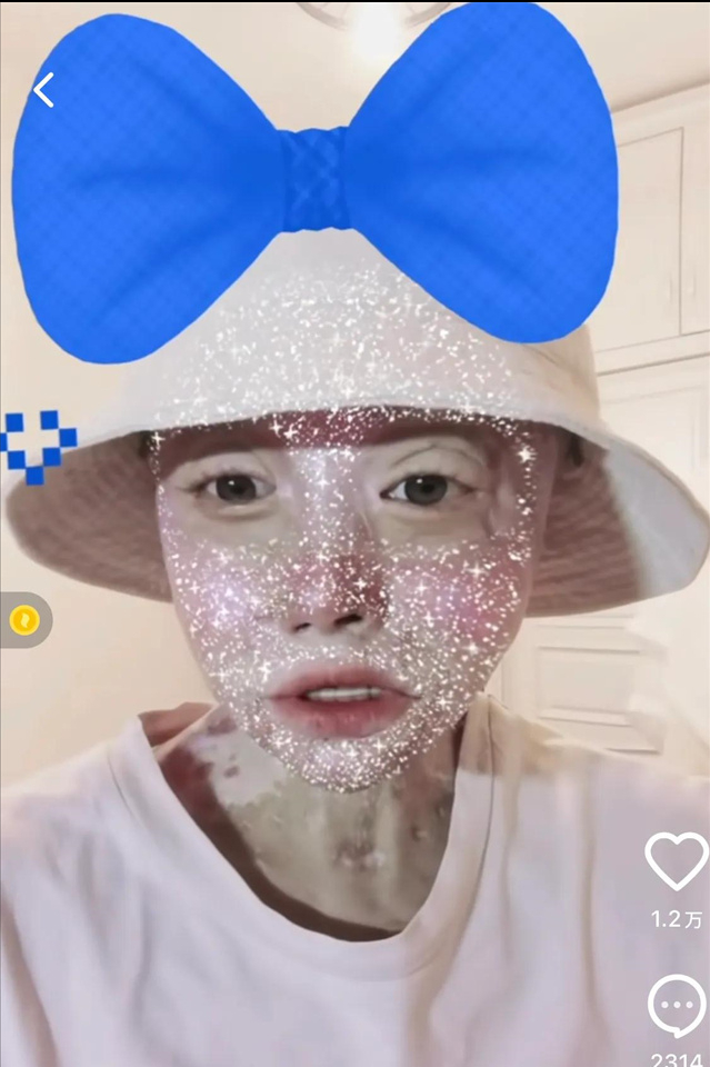 24岁女孩烧伤928天后重生!12次手术仍不放弃,向河南灾情捐500元