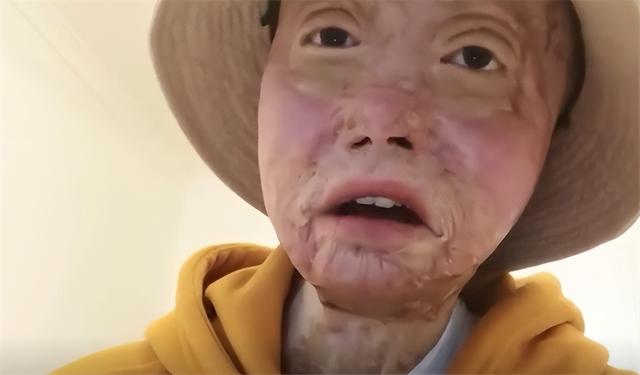 24岁女孩烧伤928天后重生!12次手术仍不放弃,向河南灾情捐500元