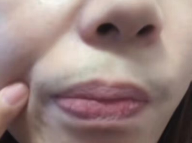 女子阳性后长浓密胡须，退烧后会显男性特征吗？