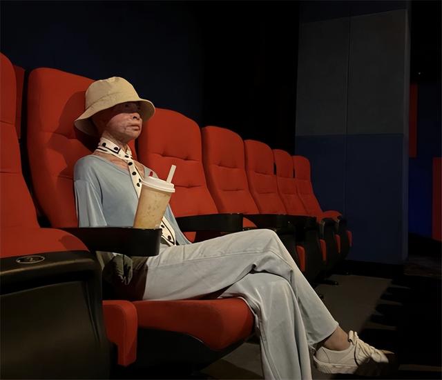 24岁女孩烧伤928天后重生!12次手术仍不放弃,向河南灾情捐500元