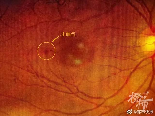 22岁“刘畊宏女孩”跳操3天眼底出血，哪个动作错了？